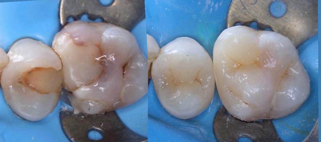 Coronas dentales reales fabricadas en el laboratorio propio de Oral Dent